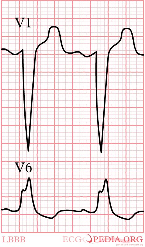 Intraventricular Conduction - ECGpedia