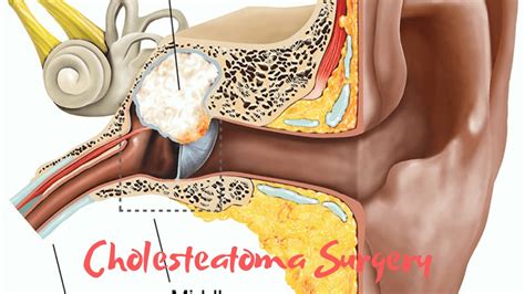 Cholesteatoma surgery - YouTube