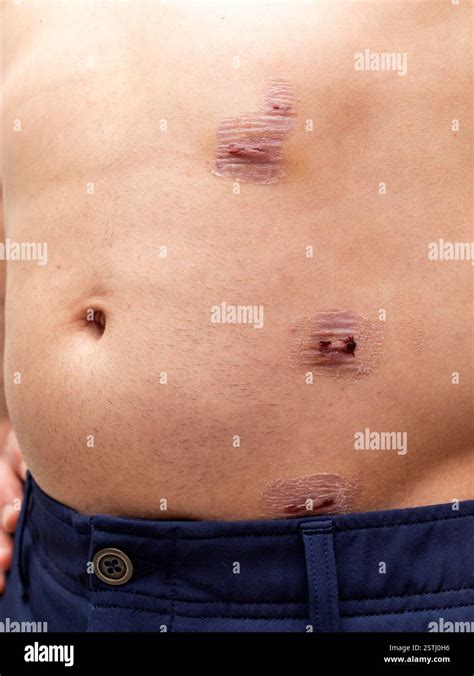 appendix removal scar