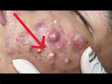 Blackheads Removal || Acne Removal - 006 - YouTube