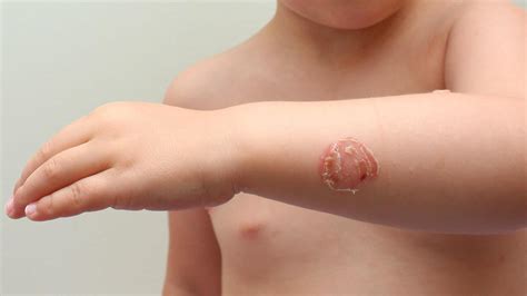 Skin allergies - symptoms and types : r/netdoctorweb