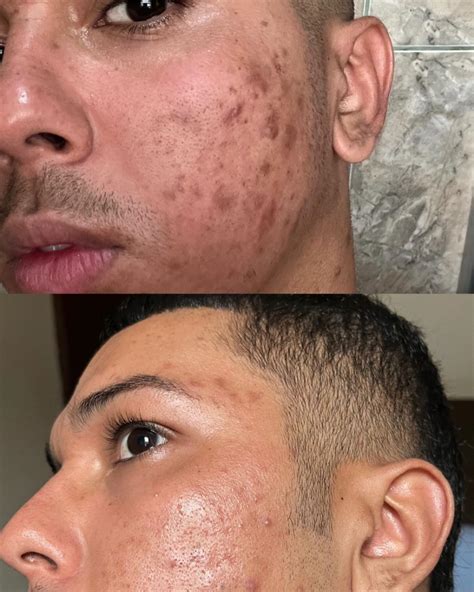 Peeling Químico Antes E Depois 1 Sessão - Cicatrizes De Acne Antes E Depois Do Peeling Quimico