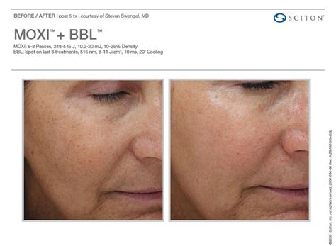 MOXI® - MOXI® Laser Treatment for Face | Becker Cosmetic