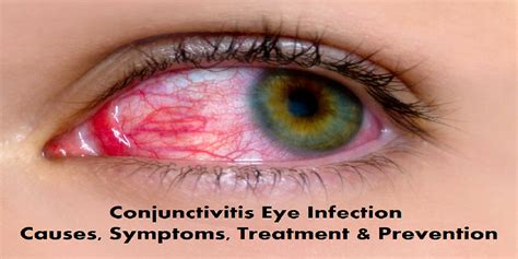 Conjunctivitis Eye Infection Causes, Symptoms, Treatment & Prevention