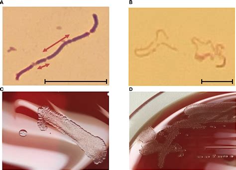human erysipelothrix rhusiopathiae infection  bath water case