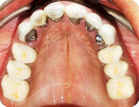 Dental Ceramics: Part II – Recent Advances in Dental Ceramics