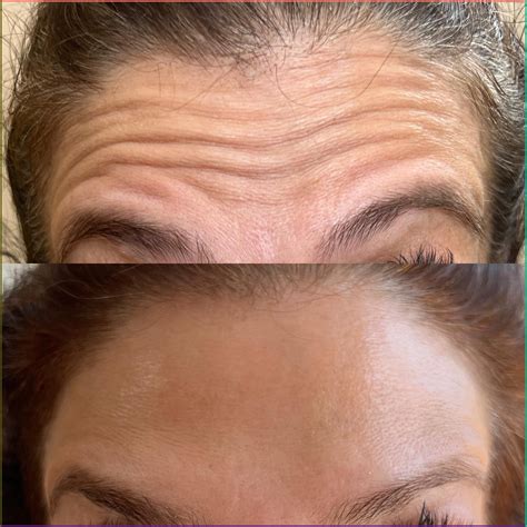 Eliminate Forehead Wrinkles: Tips and Products | Botox, Facial fillers