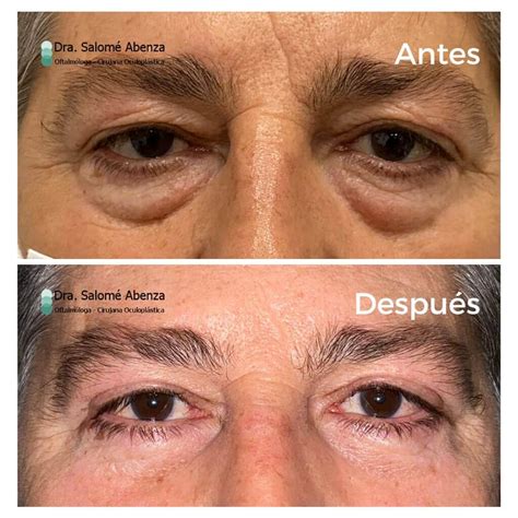 Cantopexia Antes E Depois - Blefaroplastia superior e inferior con cantopexia bilateral, con ...
