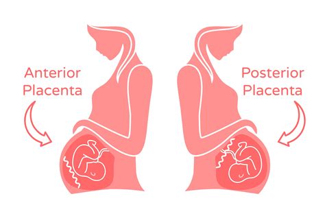 feel fetal movement   anterior placenta pregnancy