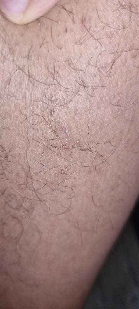 Re-infection or folliculitis? : r/scabies