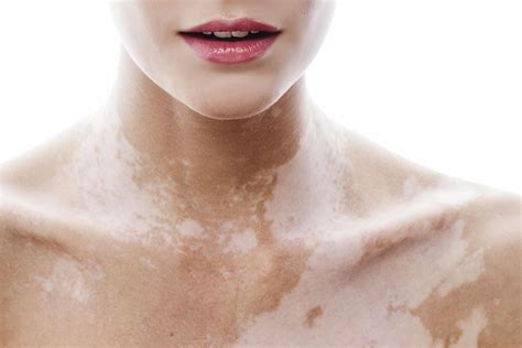 Vitiligo: Symptome, Ursachen und Therapie | BRIGITTE.de
