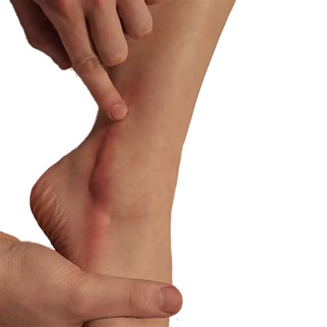 Ankle Tendon Problems - Dr Bothma