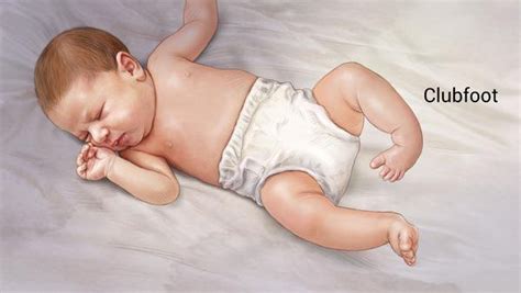 Clubfoot treatment in Iran | Best doctors & clinics | Free consultation