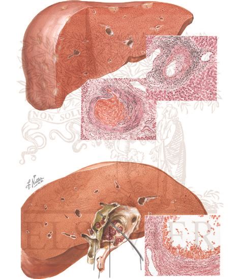 Vascular Disturbances: Periarteritis Nodosa, Aneurysm