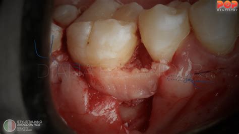 endo perio lesions simplified classification style italiano endodontics