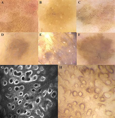JLE - European Journal of Dermatology - Correlation between super-high
