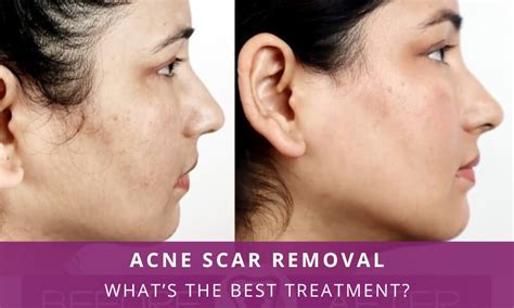 Acne Scar Removal: What’s the Best Treatment? – Richardson's Plastic ...