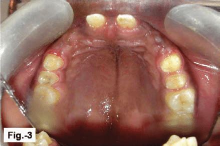 Maxillary abutment teeth preparation. | Download Scientific Diagram