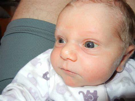 Baby Yeast Infection Neck