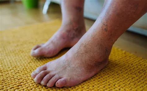 Diabetic Foot Ulcers Explained in Detail | mediSuggest