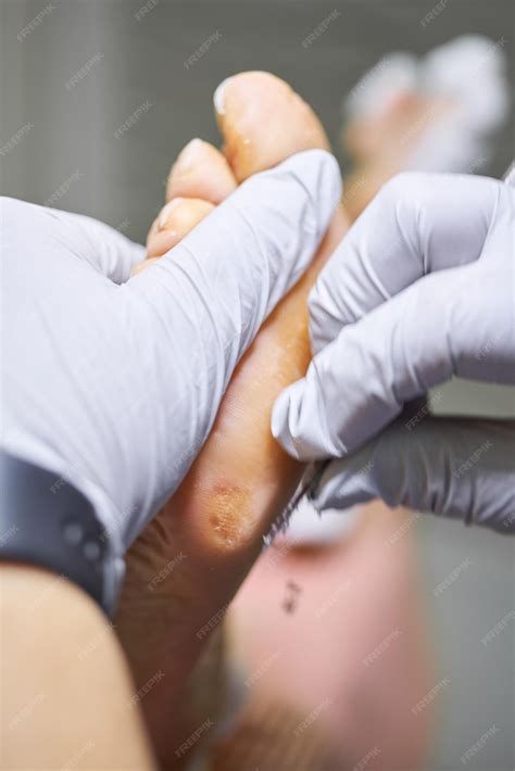 Premium Photo | Podiatry Removing calluses with a scalpel at the beautician