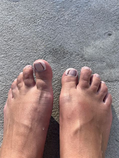 White Skin on Toes When Wet : r/DermatologyQuestions