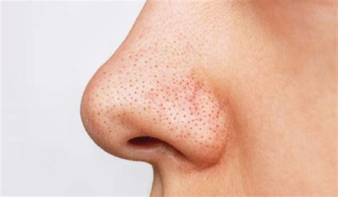 How to Get Rid of Blackheads? - Ebene Sor