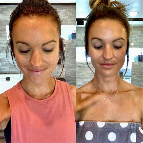 Nuface Fix Before And After - New Product Critiques, Savings, and