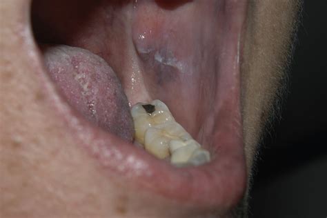 Black Spot Inside Mouth Symptoms - Infoupdate.org