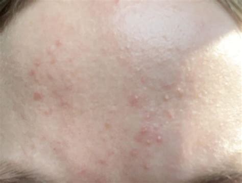 Pimples on forehead : r/AusSkincare