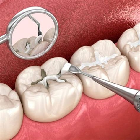 Dental Sealants | CITIDental South Boston