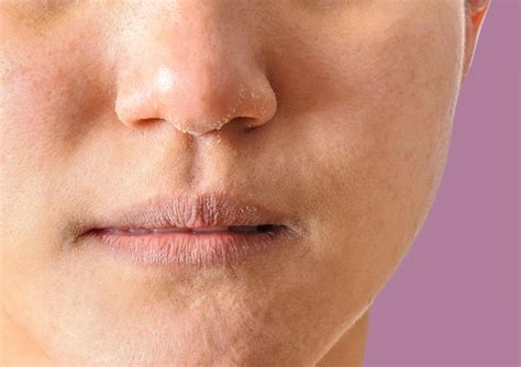 Why Do I Have Dry Patches of Skin on the Face and Body? — Moody Sisters