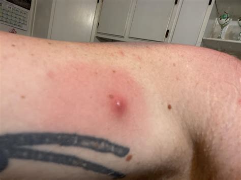 Brown Recluse Spider Bite Brown Recluse Spider Bite