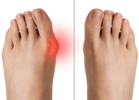 hallux valgus bunion explained  symptoms  effective