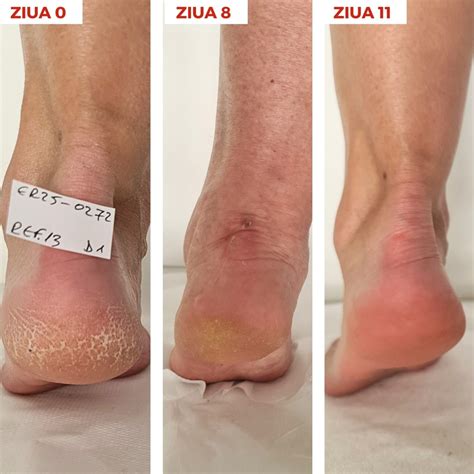 Calluses and corns/Keratoderma - Synergy Therm Cosmetics - Skincare but