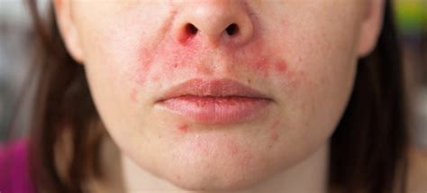 O Que É Dermatite Perioral - Dermatite Perioral O Que é - RETOEDU