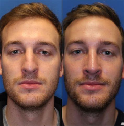 Nose Surgery Before & After Photo Gallery | San Francisco, CA | Kaiser