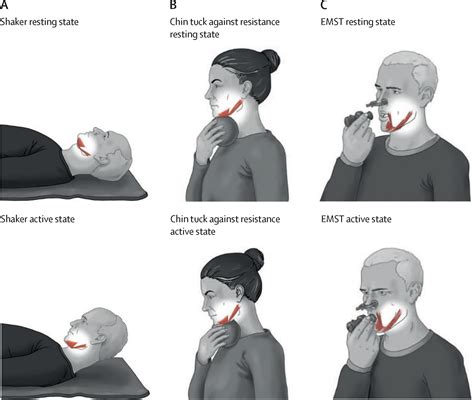 Dysphagia Stroke