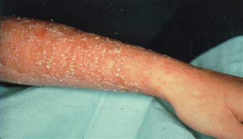 pustular psoriasis symptoms  treatment