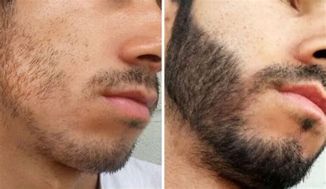 Antes E Depois Minoxidil - So Minoxidil Antes E Depois Minoxidil No Tratamento Da Queda De Cabelo