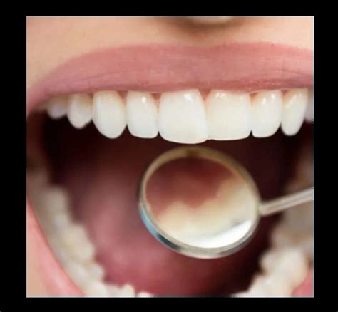 Fillings - Dentist In Dulwich, London | Rosendental