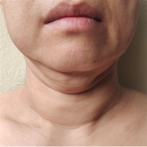 discover effective turkey neck treatment options  brisbane