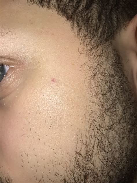 Face Rash Won't Go Away at Julia Kromer blog