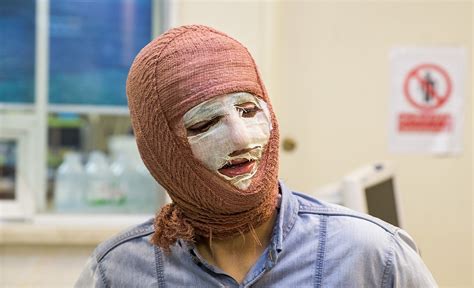 severe burn injuries surprisingly common   catastrophic