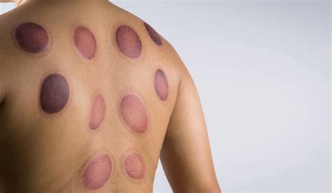 Post-Cupping Aftercare Guide: Recovery Tips to Fade Marks Fast and