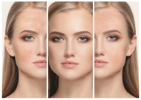 DiamondGlow Facial Treatment for skin resurfacing
