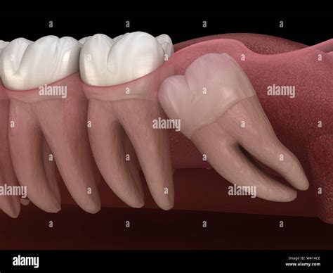 Mesial hi-res stock photography and images - Alamy