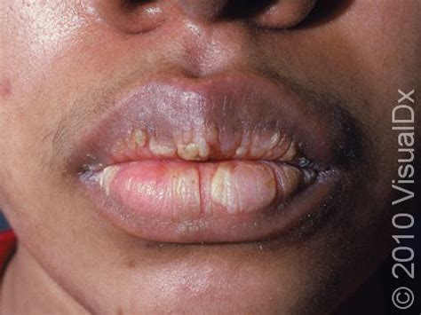 body rash  swollen lips infoupdateorg
