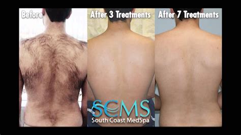 Laser Hair Removal After 3 Sessions Best Sale | centralcountiesservices.org