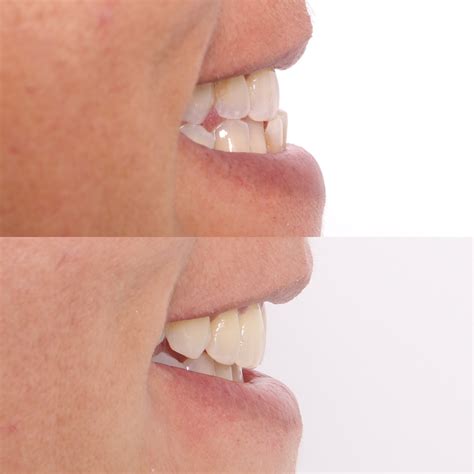 how to fix and underbite 4